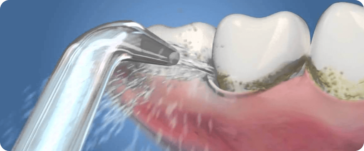 Які переваги має іригатор для зубів